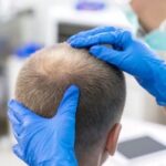 Image for hair transplant consultation