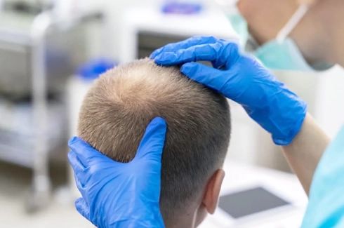 Image for hair transplant consultation